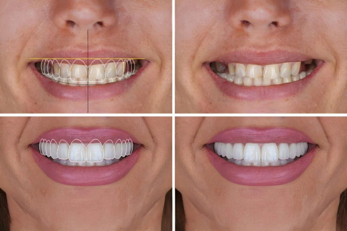 Estética Dental en Moratalaz, Clínica Dental Balleros